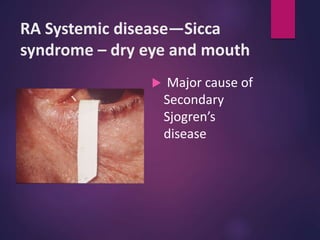 RA Systemic disease—Sicca
syndrome – dry eye and mouth
 Major cause of
Secondary
Sjogren’s
disease
 