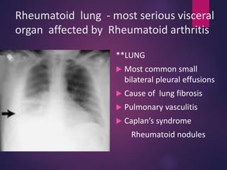 Rheumatoid lung - most serious visceral
organ affected by Rheumatoid arthritis
**LUNG
 Most common small
bilateral pleural effusions
 Cause of lung fibrosis
 Pulmonary vasculitis
 Caplan’s syndrome
Rheumatoid nodules
 