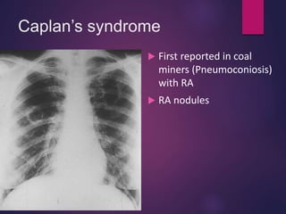 Caplan’s syndrome
 First reported in coal
miners (Pneumoconiosis)
with RA
 RA nodules
 