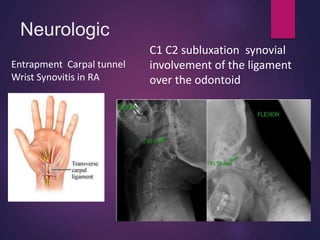 Neurologic
Entrapment Carpal tunnel
Wrist Synovitis in RA
C1 C2 subluxation synovial
involvement of the ligament
over the odontoid
 