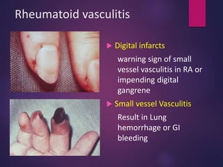 Rheumatoid vasculitis
 Digital infarcts
warning sign of small
vessel vasculitis in RA or
impending digital
gangrene
 Small vessel Vasculitis
Result in Lung
hemorrhage or GI
bleeding
 