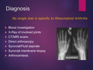 Diagnosis
 Blood investigation
 X-Ray of involved joints
 CT/MRI scans
 Direct arthroscopy
 Synovial/Fluid aspirate
 Synovial membrane biopsy
 Arthrocentesis
No single test is specific to Rheumatoid Arthritis
 