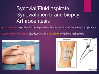 Synovial/Fluid aspirate
Synovial membrane biopsy
Arthrocentesis
Athrocentesis: synovial fluid is aspirated and analysed for inflammatory components
Abnormal synovial fluid: cloudy, milky, or dark yellow containing leukocytes
 