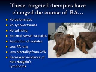 These targeted therapies have
changed the course of RA…
 No deformities
 No synovectomies
 No splinting
 No small vessel vasculitis
 Resolution of nodules
 Less RA lung
 Less Mortality from CVD
 Decreased incidence of
Non Hodgkin’s
Lymphoma
 