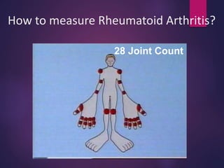 How to measure Rheumatoid Arthritis?
28 Joint Count
 