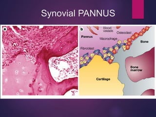 Synovial PANNUS
 
