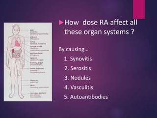 How dose RA affect all
these organ systems ?
By causing…
1. Synovitis
2. Serositis
3. Nodules
4. Vasculitis
5. Autoantibodies
 