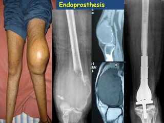 Endoprosthesis
 