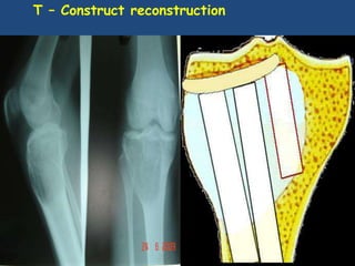 Tconstruct Reeds benign bone tumors contd... | PPTX
