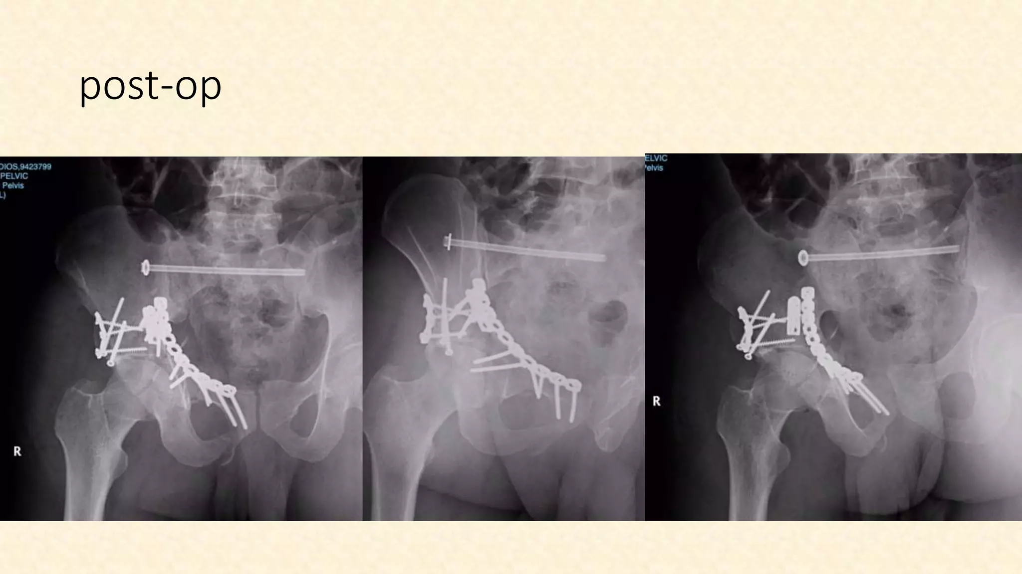 A new anterior acetabular approach | PPTX