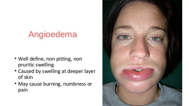 Anaphylactic