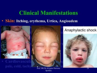 Prof. DR.Dr.Ariyanto Harsono
SpA(K)
24
Clinical Manifestations
• Skin: Itching, erythema, Urtica, Angioudem
• Respiratory: sneezing, runny nose, clogged,
coughing, wheezing; swollen larynx: tightness,
hoarseness, stridor, cyanosis
• Digestive: nausea, Mutah, diarrhea, abdominal
pain
• Eyes: itching, tears
• Cardiovascular: collapse, fainting, hypotension,
pale, cold, tachycardia, arrhythmias, cardiac arrest
 