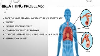 BREATHING PROBLEMS:
• SHORTNESS OF BREATH – INCREASED RESPIRATORY RATE.
• WHEEZE.
• PATIENT BECOMING TIRED.
• CONFUSION CAUSED BY HYPOXIA.
• CYANOSIS (APPEARS BLUE) – THIS IS USUALLY A LATE SIGN.
• RESPIRATORY ARREST.
 