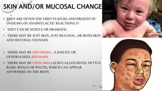SKIN AND/OR MUCOSAL CHANGES
• THEY ARE OFTEN THE FIRST FEATURE AND PRESENT IN
OVER 80% OF ANAPHYLACTIC REACTIONS.33
• THEY CAN BE SUBTLE OR DRAMATIC.
• THERE MAY BE JUST SKIN, JUST MUCOSAL, OR BOTH SKIN
AND MUCOSAL CHANGES.
• THERE MAY BE ERYTHEMA – A PATCHY, OR
GENERALISED, RED RASH.
• THERE MAY BE URTICARIA (ALSO CALLED HIVES, NETTLE
RASH, WEALS OR WELTS), WHICH CAN APPEAR
ANYWHERE ON THE BODY.
 