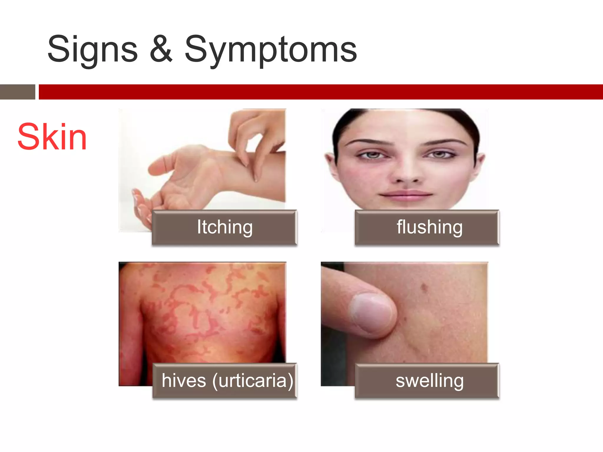 Signs & Symptoms

Skin

           Itching         flushing




       hives (urticaria)   swelling
 