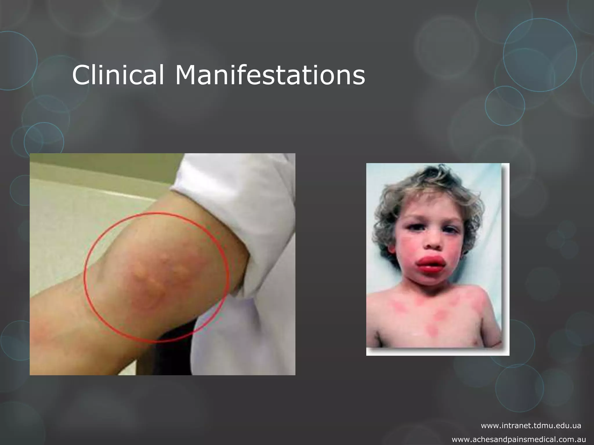 Clinical Manifestations

www.intranet.tdmu.edu.ua
www.achesandpainsmedical.com.au

 