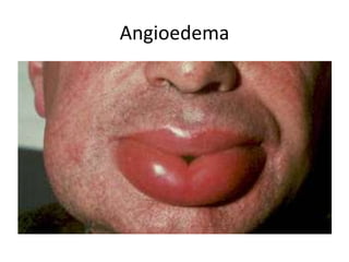 Angioedema
 