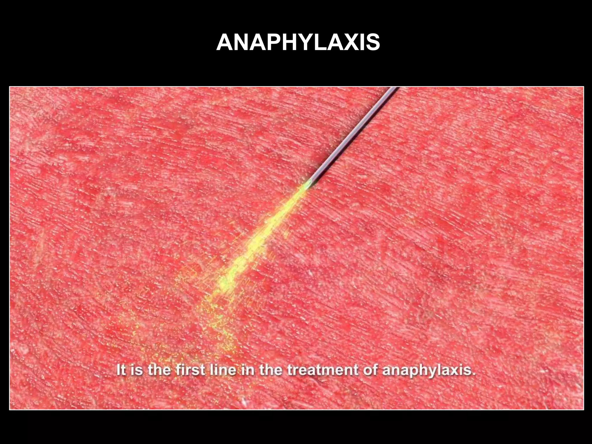 ANAPHYLAXIS
 