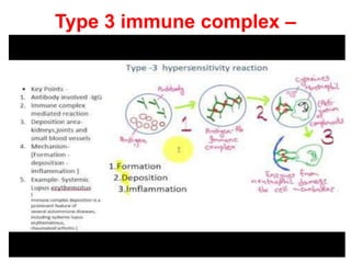 Type 3 immune complex –
mediated hypersensitivity
 
