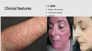 Clinical features
• 1: SKIN
 Begins with pruritus
 Cutaneous fushing
 Urticaria
 