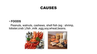 CAUSES
• FOODS
Peanuts, walnuts, cashews, shell fish (eg : shrimp,
lobster,crab ),fish ,milk ,egg,soy,wheat,beans.
 