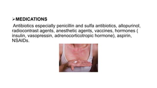 MEDICATIONS
Antibiotics especially penicillin and sulfa antibiotics, allopurinol,
radiocontrast agents, anesthetic agents, vaccines, hormones (
insulin, vasopressin, adrenocorticotropic hormone), aspirin,
NSAIDs.
 