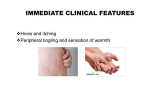 IMMEDIATE CLINICAL FEATURES
Hives and itching
Peripheral tingling and sensation of warmth
 