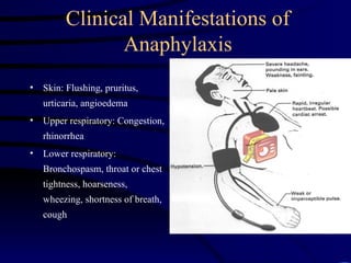 Clinical Manifestations of
Anaphylaxis
• Skin: Flushing, pruritus,
urticaria, angioedema
• Upper respiratory: Congestion,
rhinorrhea
• Lower respiratory:
Bronchospasm, throat or chest
tightness, hoarseness,
wheezing, shortness of breath,
cough
 