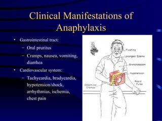 Clinical Manifestations of
Anaphylaxis
• Gastrointestinal tract:
– Oral pruritus
– Cramps, nausea, vomiting,
diarrhea
• Cardiovascular system:
– Tachycardia, bradycardia,
hypotension/shock,
arrhythmias, ischemia,
chest pain
 