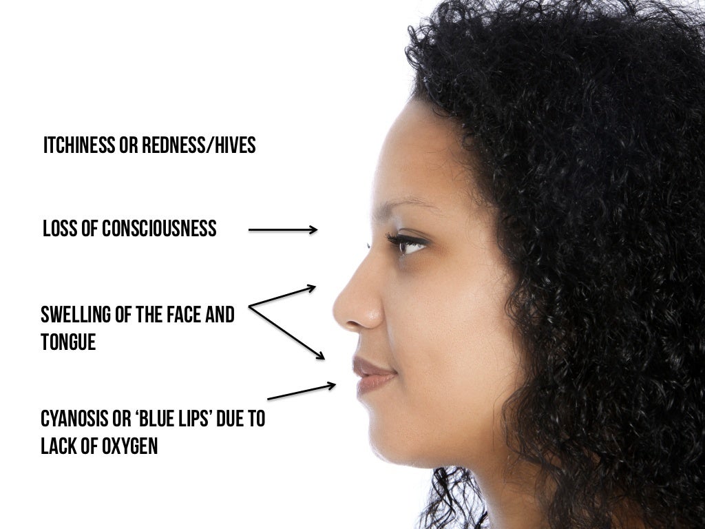 Cyanosis or ‘blue lips’ due