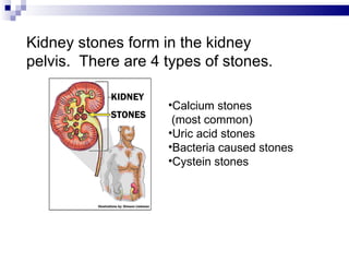Kidney stones form in the kidney pelvis.  There are 4 types of stones. Calcium stones  (most common) Uric acid stones Bacteria caused stones Cystein stones 