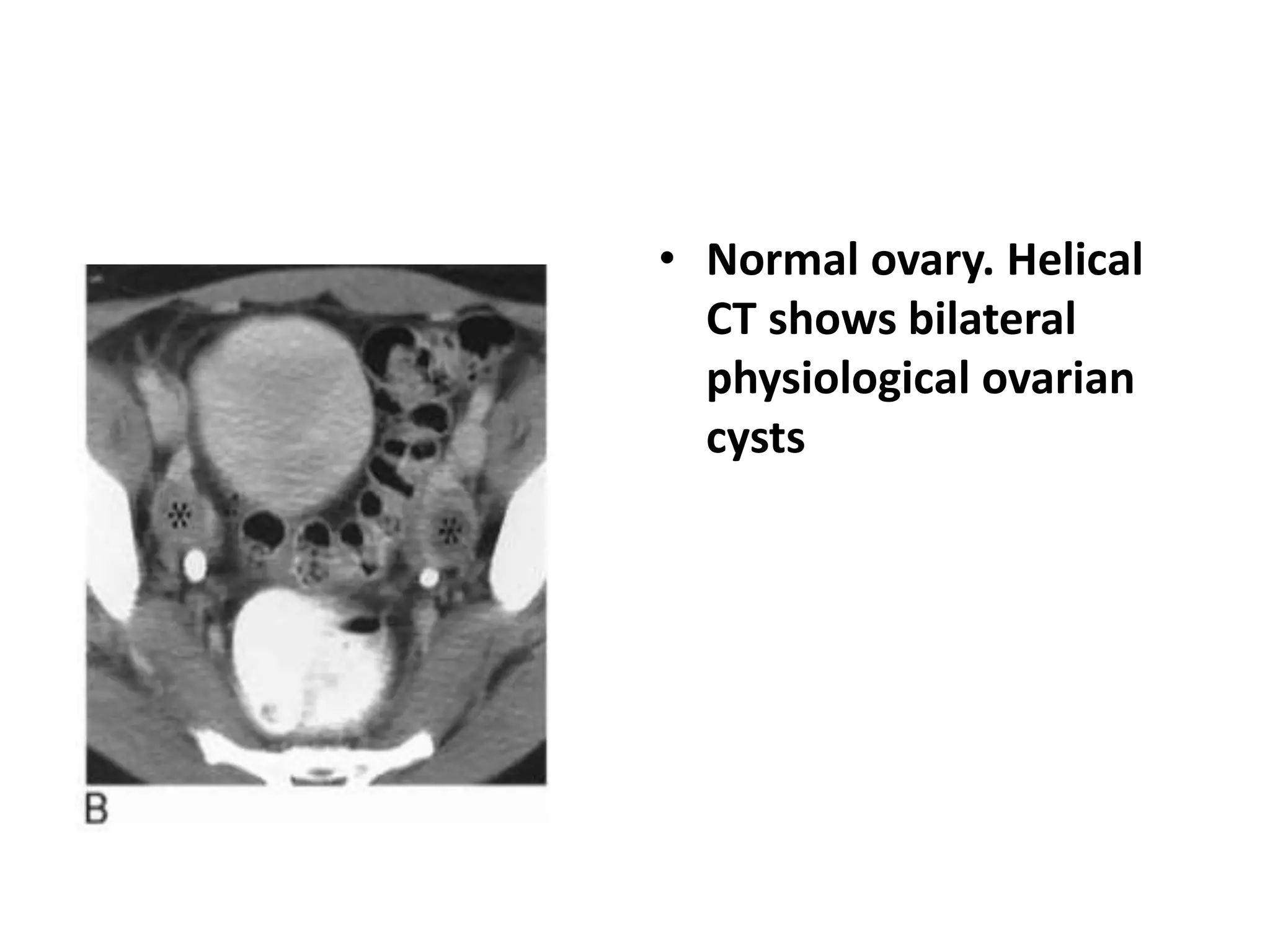 • Normal ovary. Helical
CT shows bilateral
physiological ovarian
cysts
 