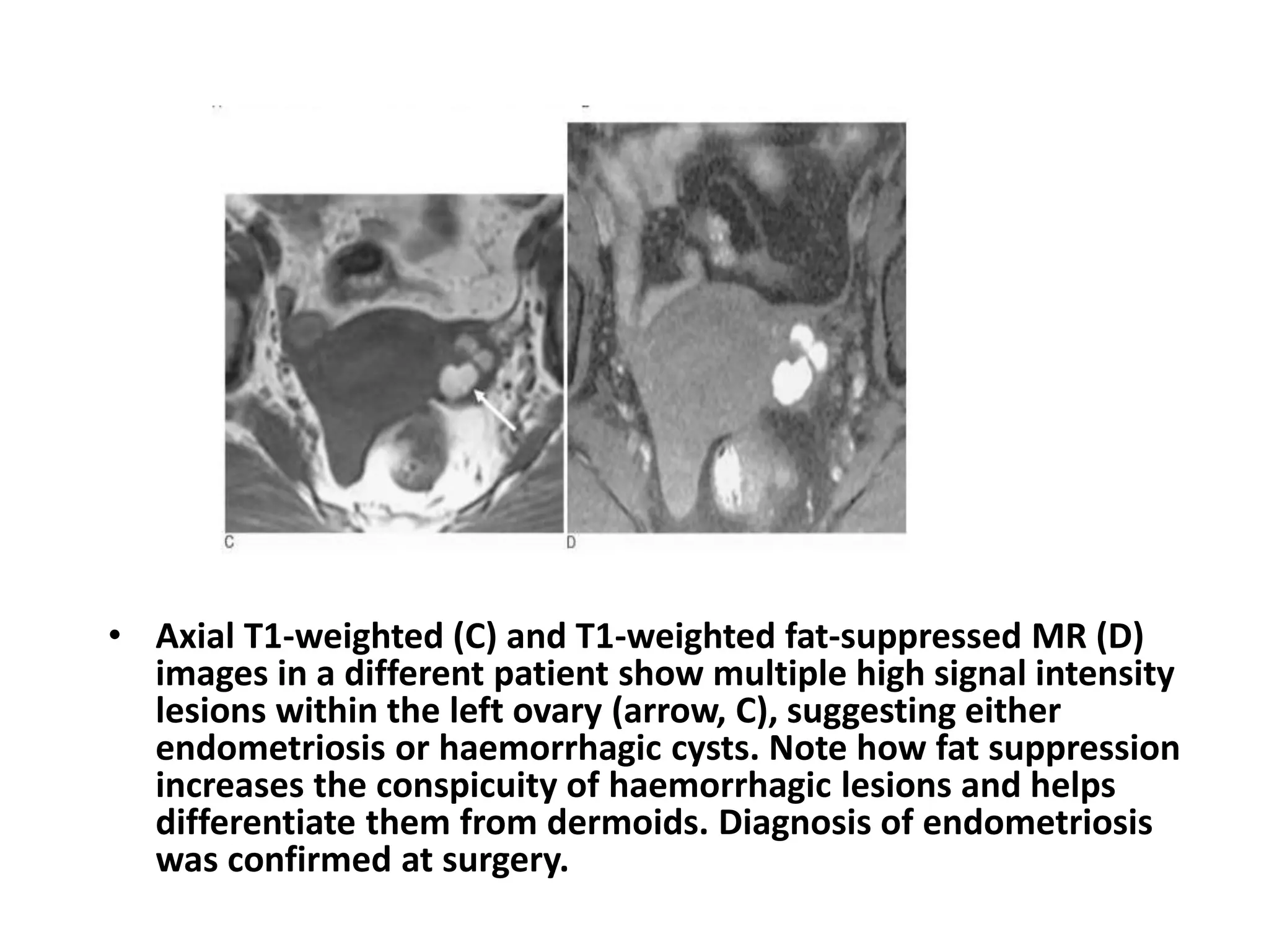 • Axial T1-weighted (C) and T1-weighted fat-suppressed MR (D)
images in a different patient show multiple high signal intensity
lesions within the left ovary (arrow, C), suggesting either
endometriosis or haemorrhagic cysts. Note how fat suppression
increases the conspicuity of haemorrhagic lesions and helps
differentiate them from dermoids. Diagnosis of endometriosis
was confirmed at surgery.
 