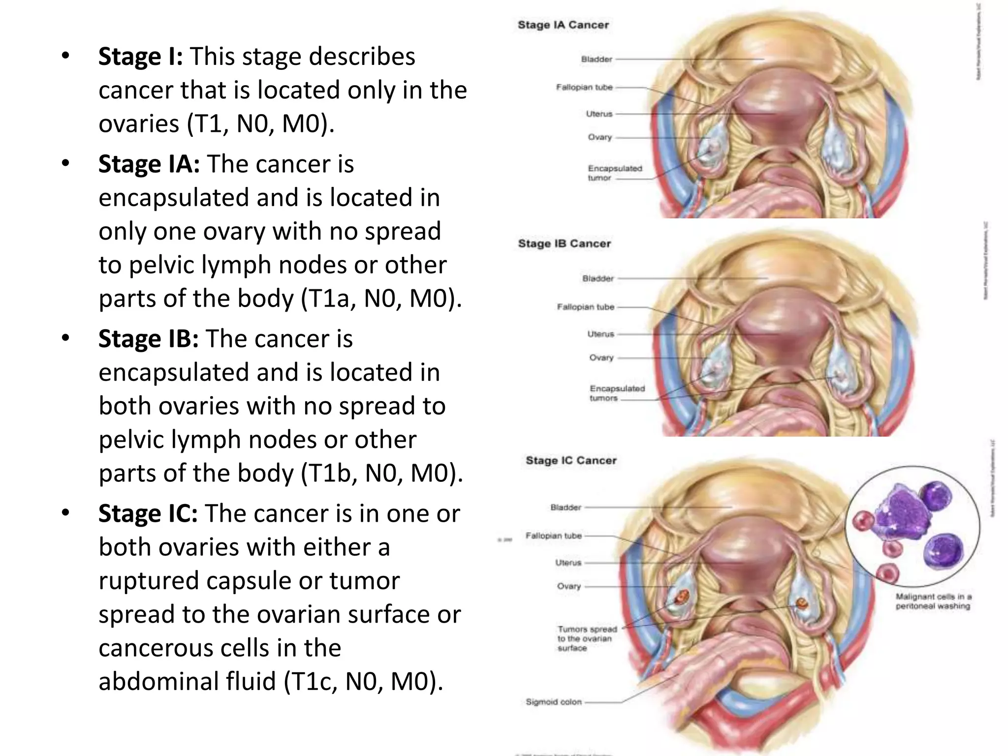 • Stage I: This stage describes
cancer that is located only in the
ovaries (T1, N0, M0).
• Stage IA: The cancer is
encapsulated and is located in
only one ovary with no spread
to pelvic lymph nodes or other
parts of the body (T1a, N0, M0).
• Stage IB: The cancer is
encapsulated and is located in
both ovaries with no spread to
pelvic lymph nodes or other
parts of the body (T1b, N0, M0).
• Stage IC: The cancer is in one or
both ovaries with either a
ruptured capsule or tumor
spread to the ovarian surface or
cancerous cells in the
abdominal fluid (T1c, N0, M0).
 