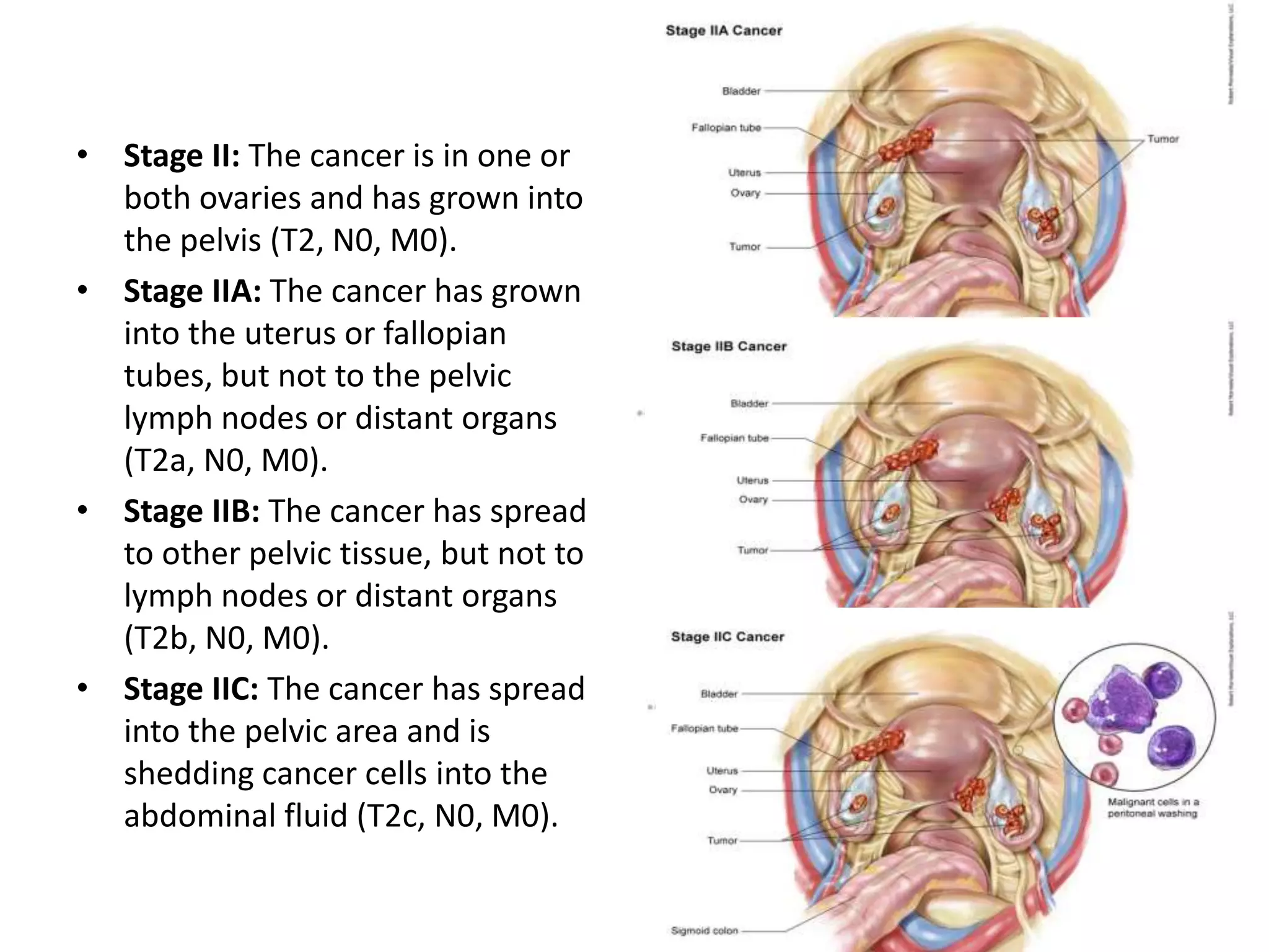 • Stage II: The cancer is in one or
both ovaries and has grown into
the pelvis (T2, N0, M0).
• Stage IIA: The cancer has grown
into the uterus or fallopian
tubes, but not to the pelvic
lymph nodes or distant organs
(T2a, N0, M0).
• Stage IIB: The cancer has spread
to other pelvic tissue, but not to
lymph nodes or distant organs
(T2b, N0, M0).
• Stage IIC: The cancer has spread
into the pelvic area and is
shedding cancer cells into the
abdominal fluid (T2c, N0, M0).
 