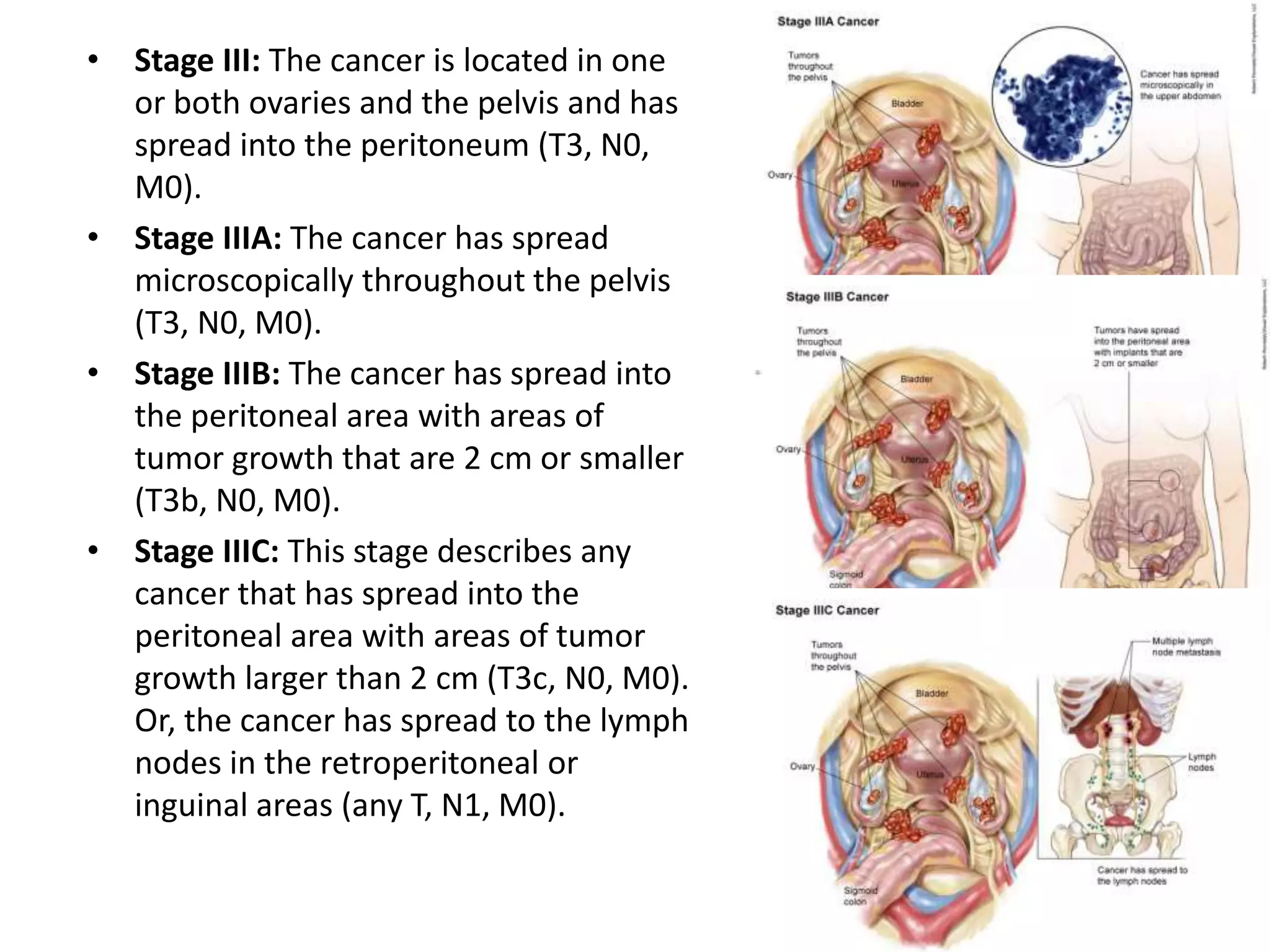 • Stage III: The cancer is located in one
or both ovaries and the pelvis and has
spread into the peritoneum (T3, N0,
M0).
• Stage IIIA: The cancer has spread
microscopically throughout the pelvis
(T3, N0, M0).
• Stage IIIB: The cancer has spread into
the peritoneal area with areas of
tumor growth that are 2 cm or smaller
(T3b, N0, M0).
• Stage IIIC: This stage describes any
cancer that has spread into the
peritoneal area with areas of tumor
growth larger than 2 cm (T3c, N0, M0).
Or, the cancer has spread to the lymph
nodes in the retroperitoneal or
inguinal areas (any T, N1, M0).
 