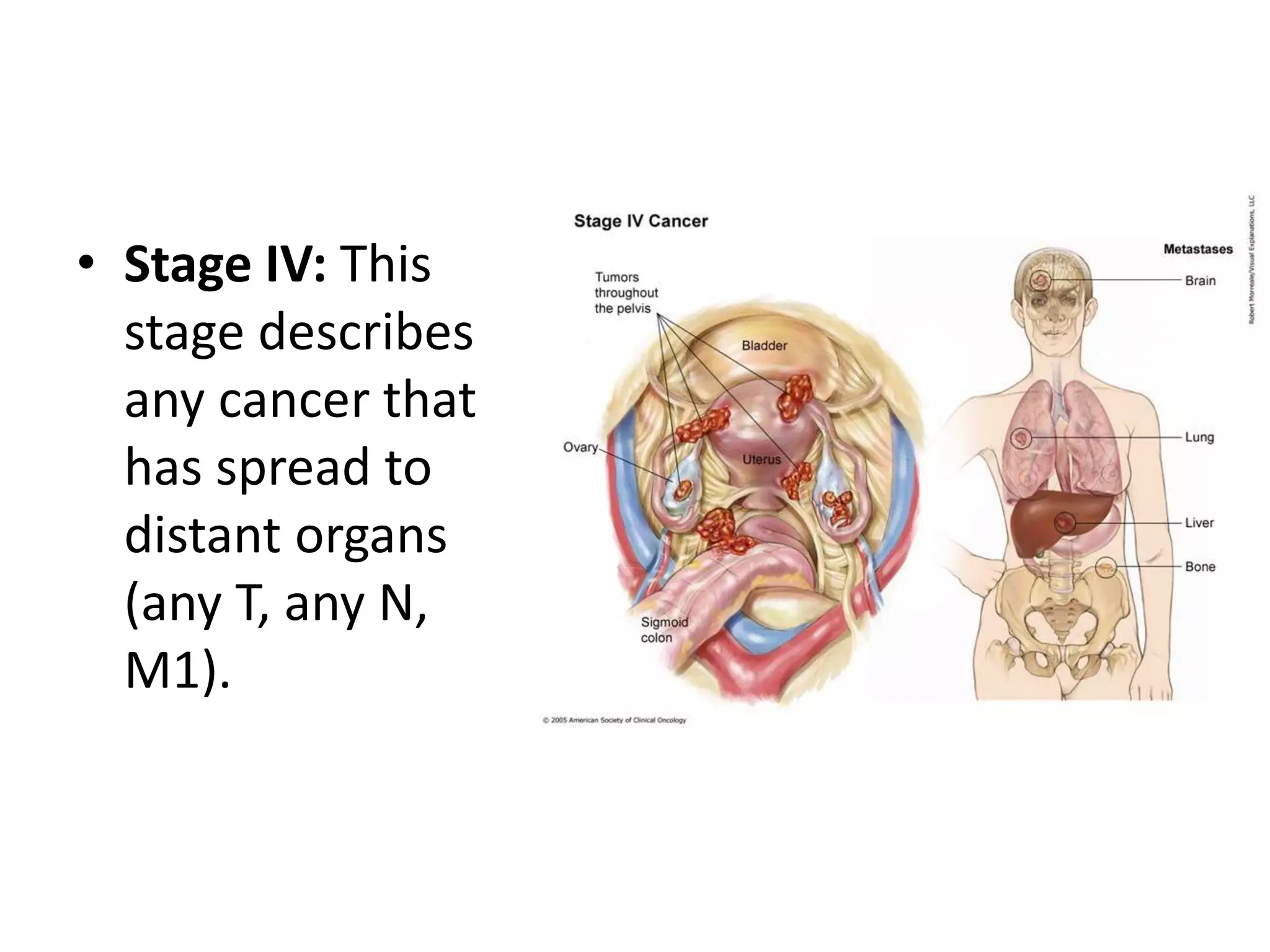 • Stage IV: This
stage describes
any cancer that
has spread to
distant organs
(any T, any N,
M1).
 