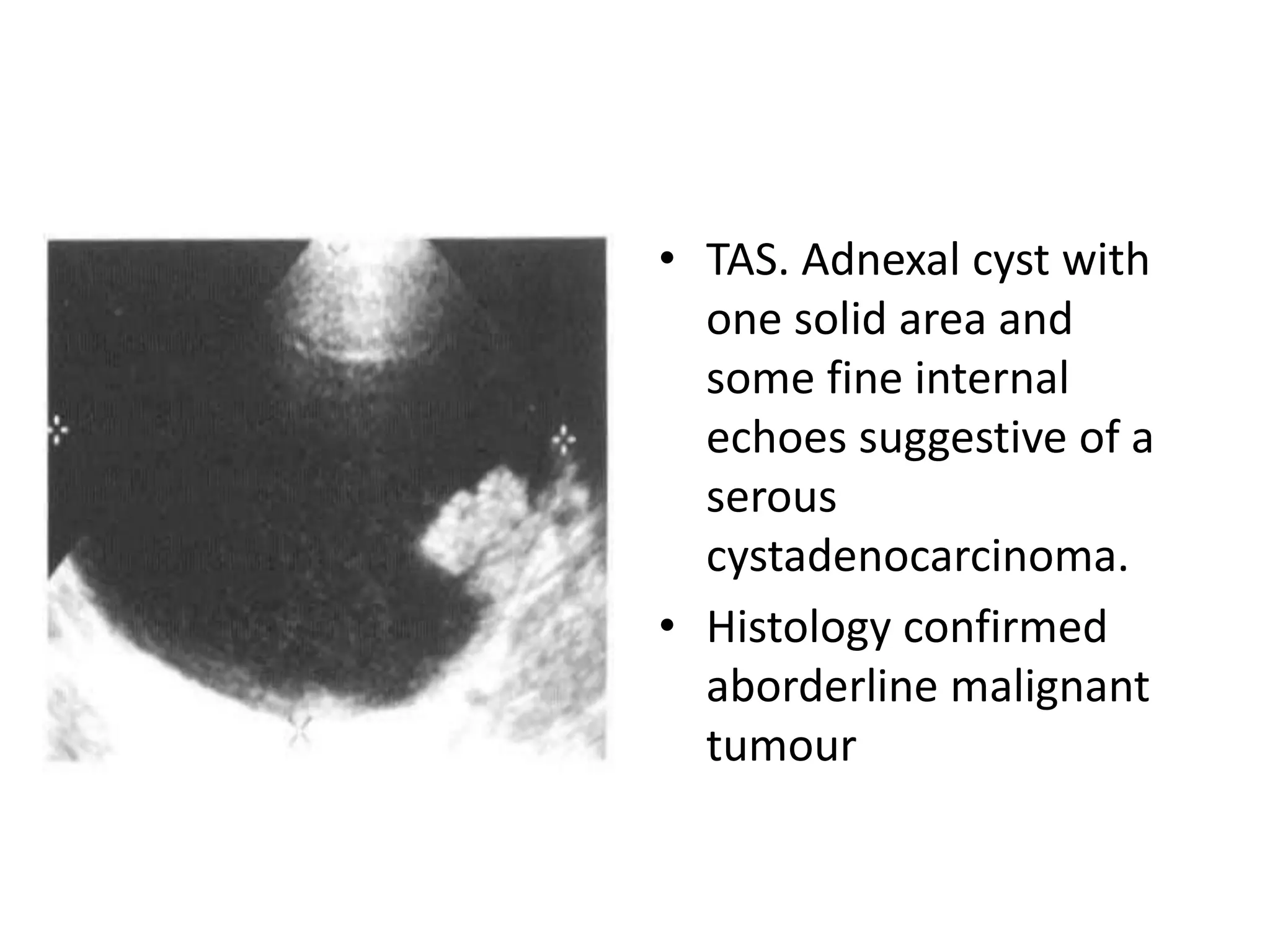 • TAS. Adnexal cyst with
one solid area and
some fine internal
echoes suggestive of a
serous
cystadenocarcinoma.
• Histology confirmed
aborderline malignant
tumour
 