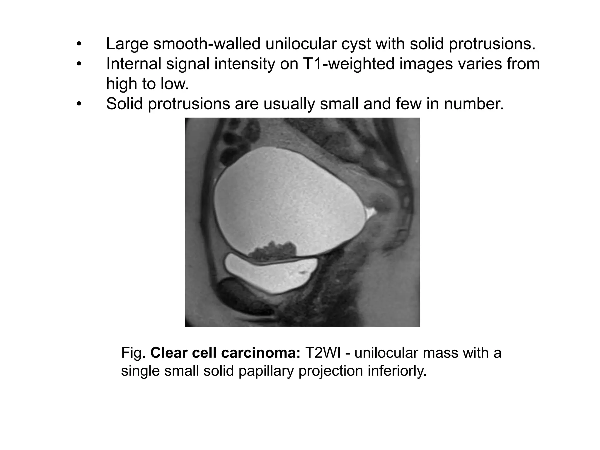 Fig. Clear cell carcinoma: T2WI - unilocular mass with a
single small solid papillary projection inferiorly.
• Large smooth-walled unilocular cyst with solid protrusions.
• Internal signal intensity on T1-weighted images varies from
high to low.
• Solid protrusions are usually small and few in number.
 