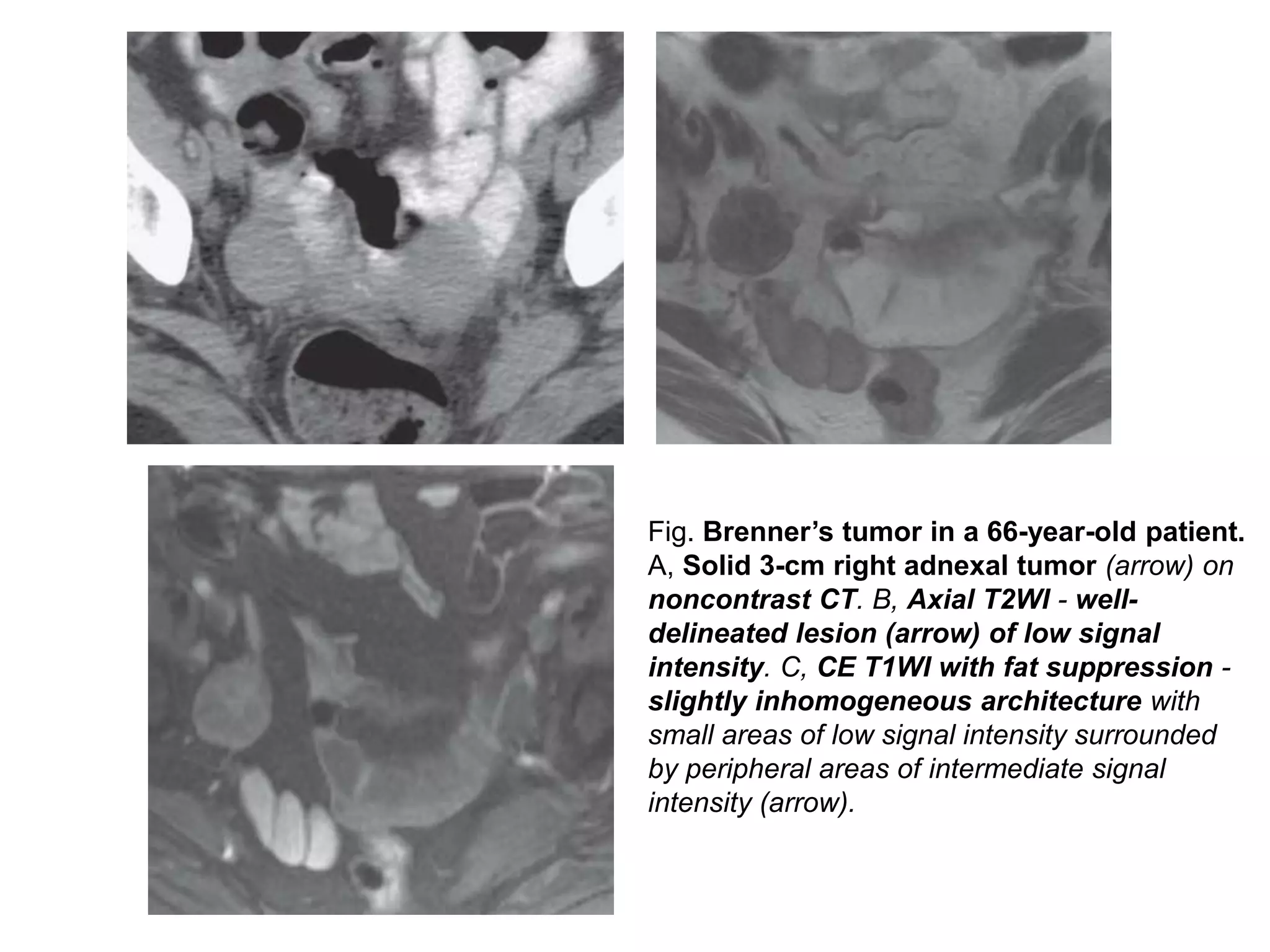 Fig. Brenner’s tumor in a 66-year-old patient.
A, Solid 3-cm right adnexal tumor (arrow) on
noncontrast CT. B, Axial T2WI - well-
delineated lesion (arrow) of low signal
intensity. C, CE T1WI with fat suppression -
slightly inhomogeneous architecture with
small areas of low signal intensity surrounded
by peripheral areas of intermediate signal
intensity (arrow).
 