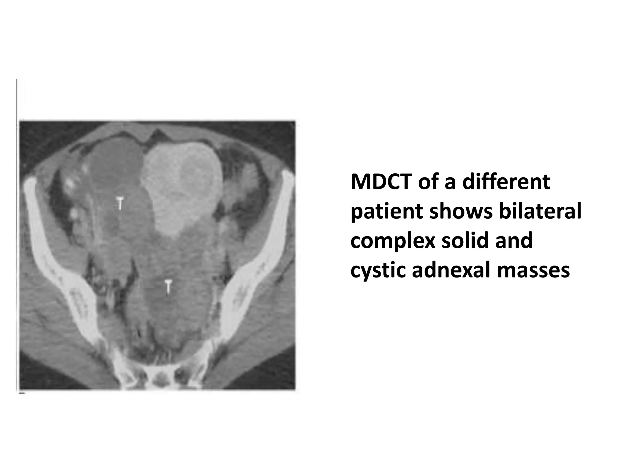 • MDCT of a different
patient shows bilateral
complex solid and
cystic adnexal masses
 