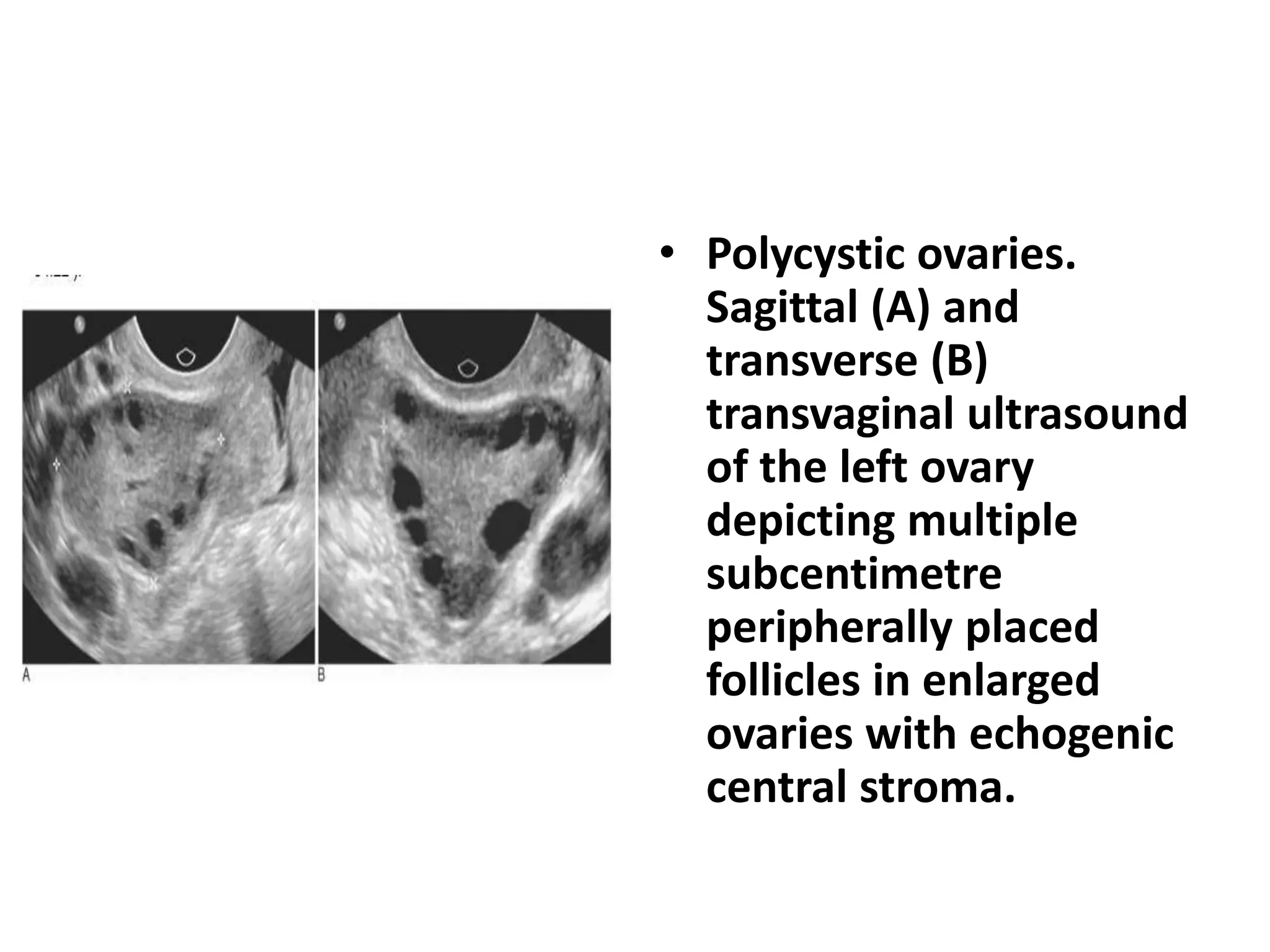 • Polycystic ovaries.
Sagittal (A) and
transverse (B)
transvaginal ultrasound
of the left ovary
depicting multiple
subcentimetre
peripherally placed
follicles in enlarged
ovaries with echogenic
central stroma.
 