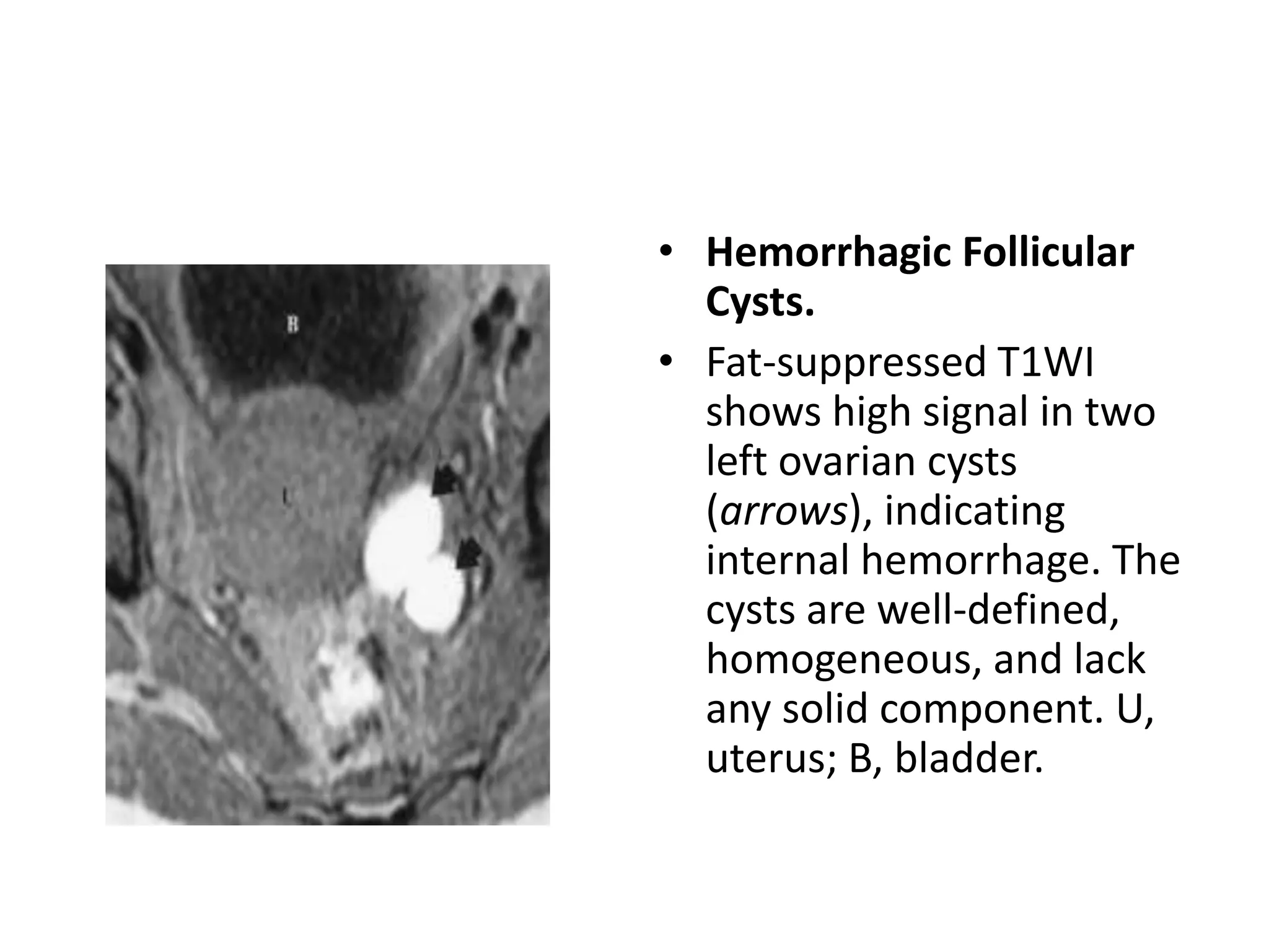 • Hemorrhagic Follicular
Cysts.
• Fat-suppressed T1WI
shows high signal in two
left ovarian cysts
(arrows), indicating
internal hemorrhage. The
cysts are well-defined,
homogeneous, and lack
any solid component. U,
uterus; B, bladder.
 