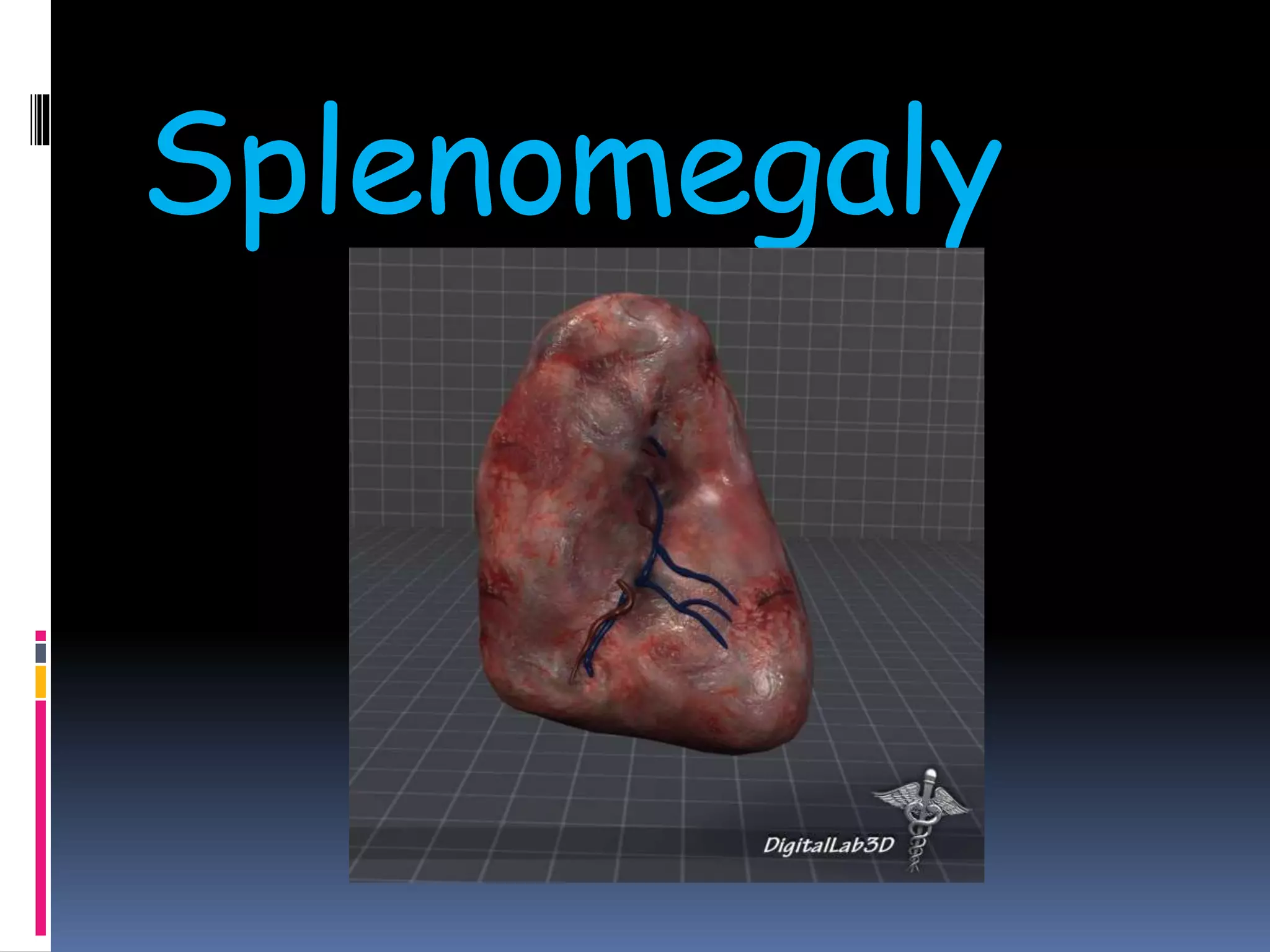 Splenomegaly
 