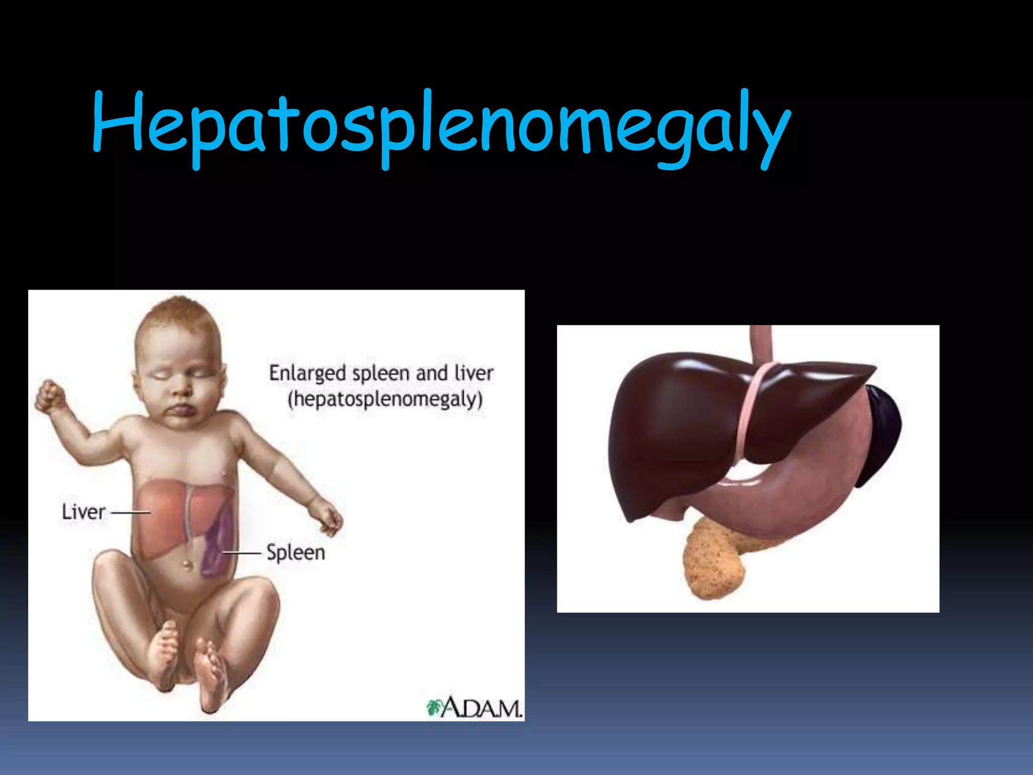 Hepatosplenomegaly
 