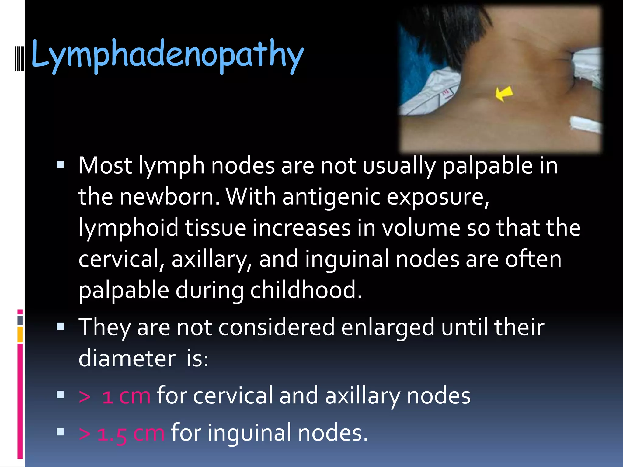 Lymphadenopathy
 Most lymph nodes are not usually palpable in
the newborn.With antigenic exposure,
lymphoid tissue increases in volume so that the
cervical, axillary, and inguinal nodes are often
palpable during childhood.
 They are not considered enlarged until their
diameter is:
 > 1 cm for cervical and axillary nodes
 > 1.5 cm for inguinal nodes.
 