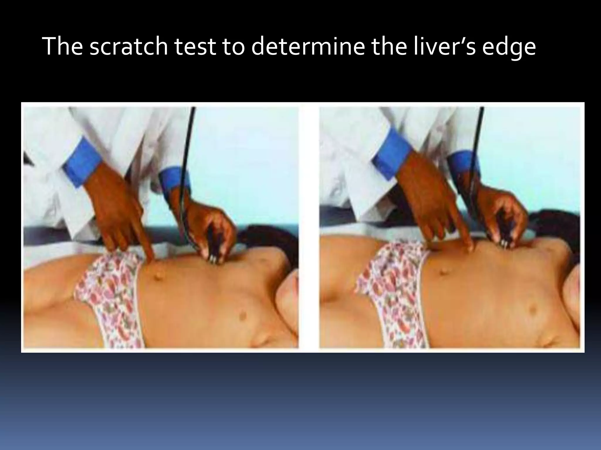 The scratch test to determine the liver’s edge
 