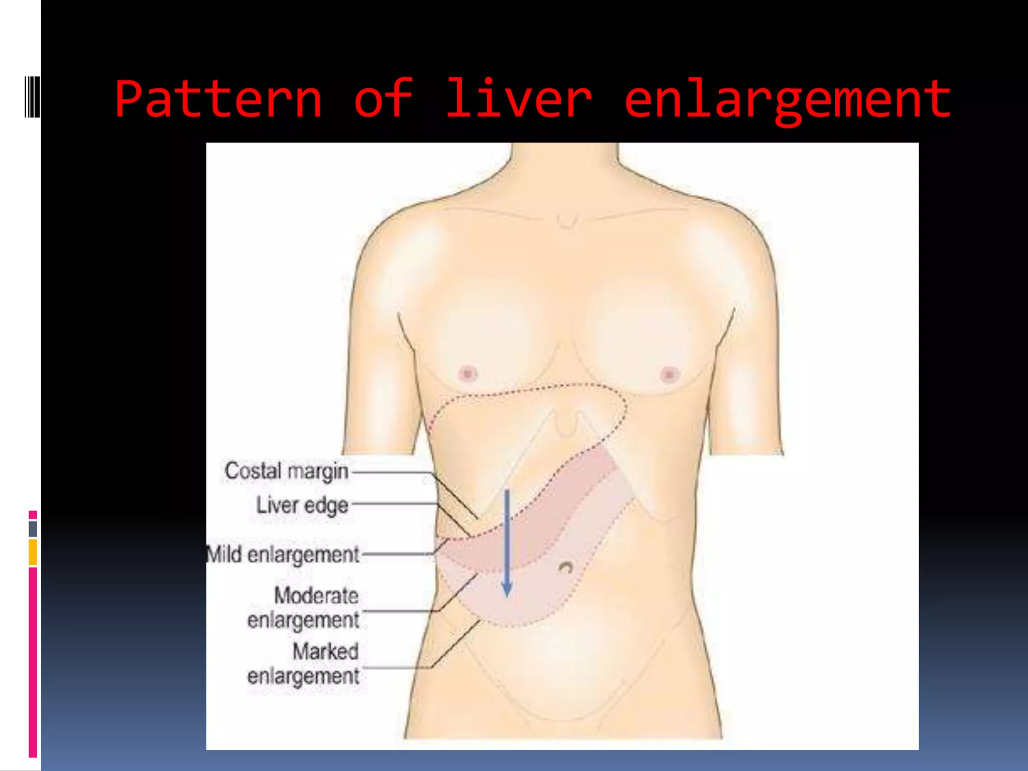 Pattern of liver enlargement
 