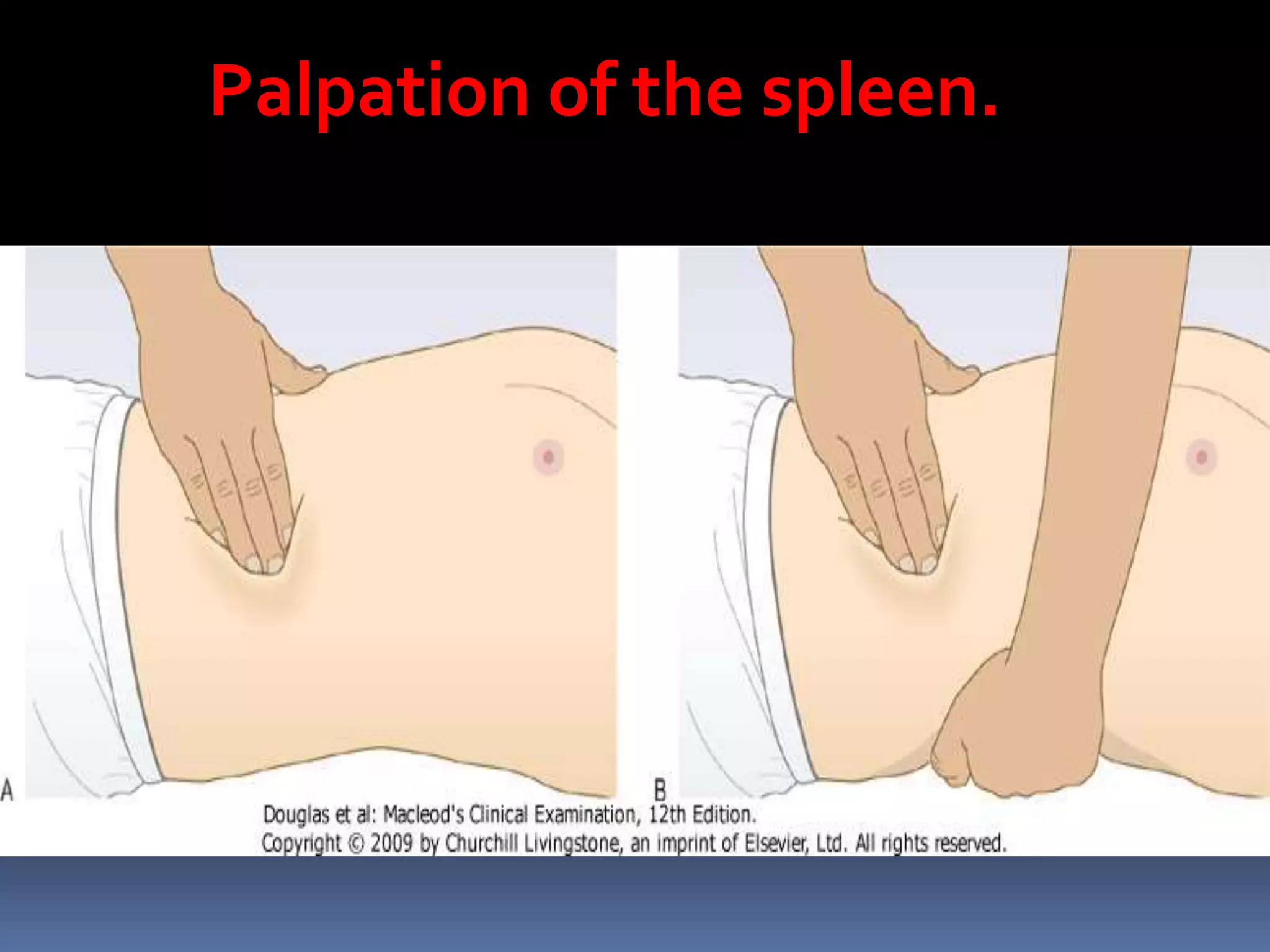 Palpation of the spleen.
 