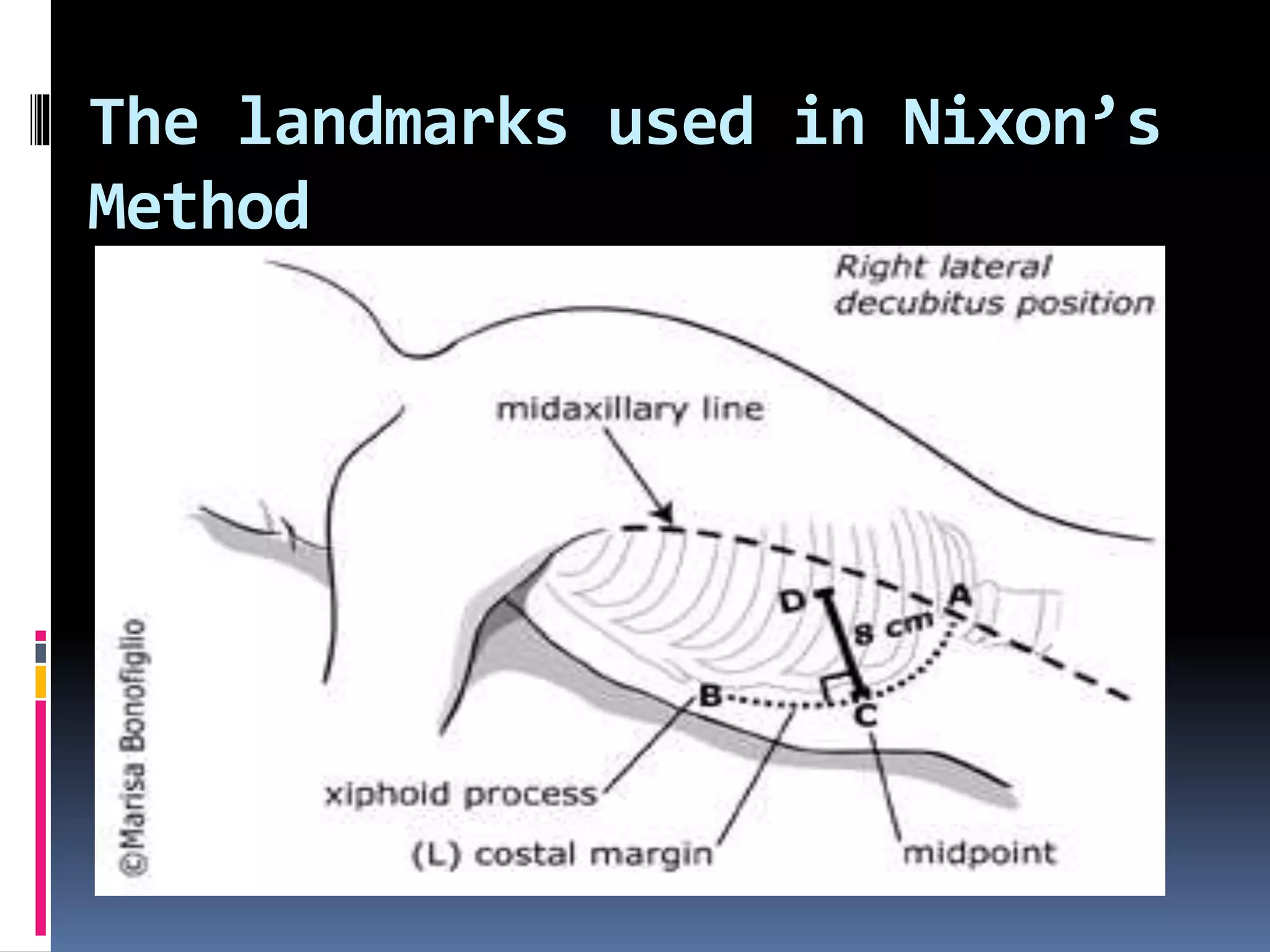 The landmarks used in Nixon’s
Method
 